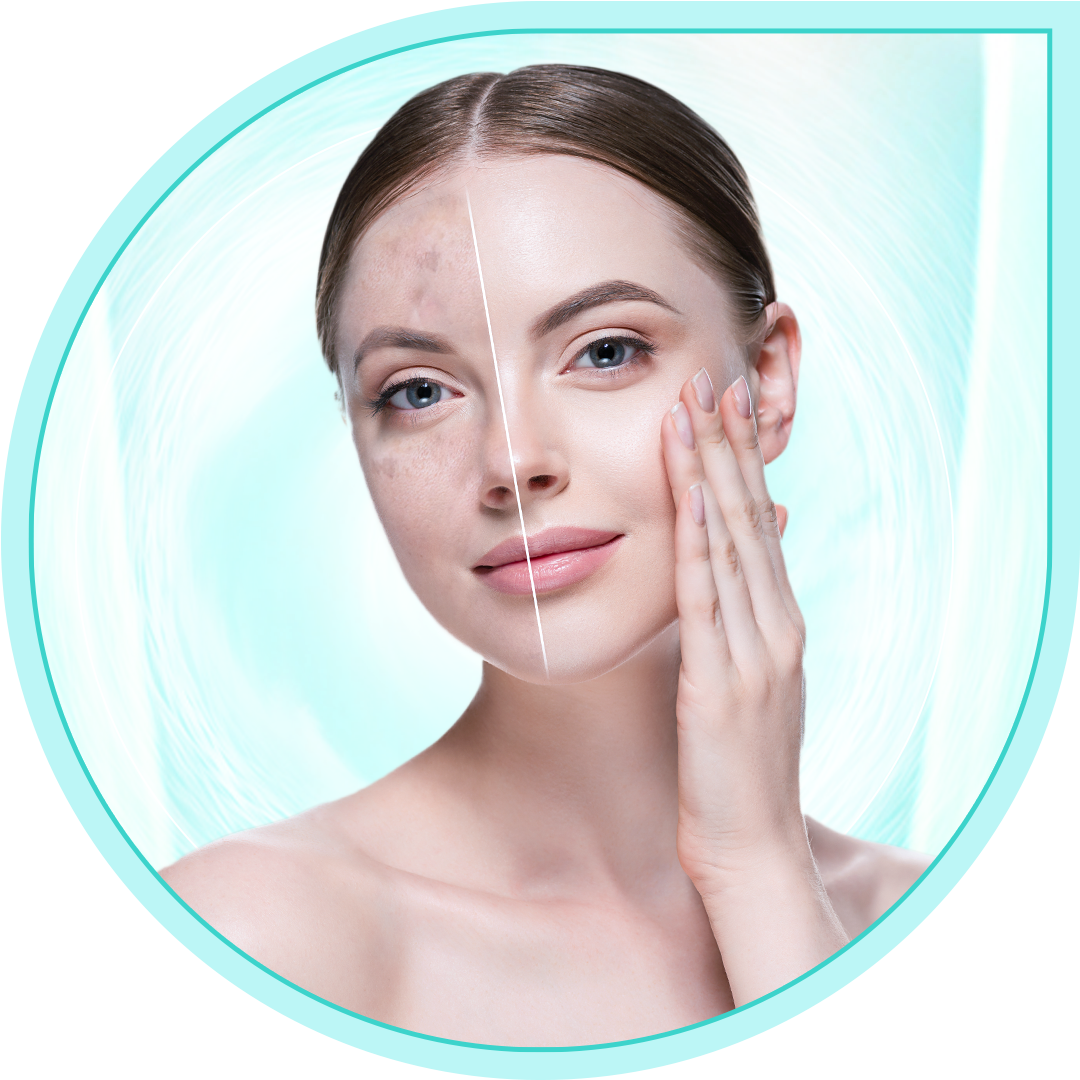 Hyperpigmentation & Melasma Care